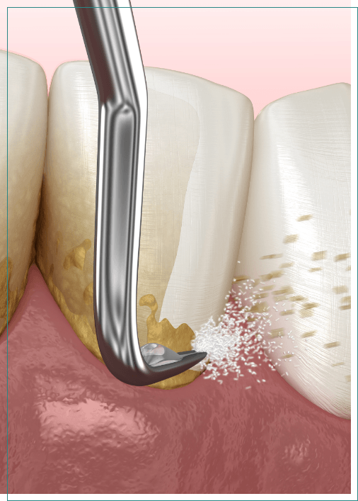 Illustrated dental instrument cleaning plaque from teeth during gum disease treatment