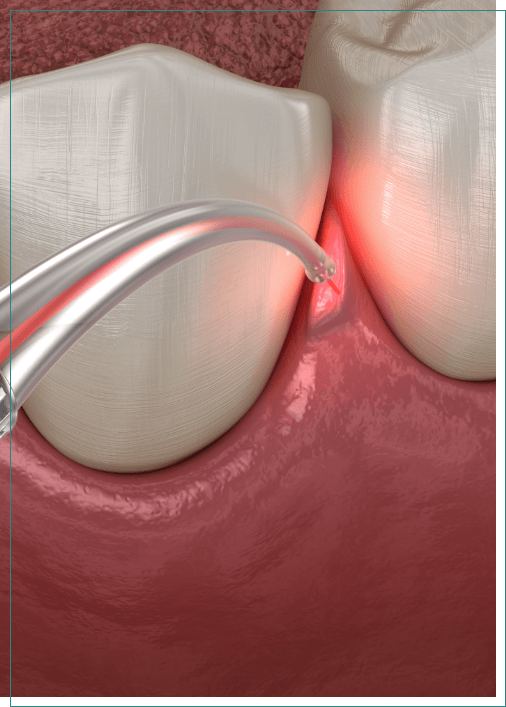 Illustrated dental laser treating gum disease