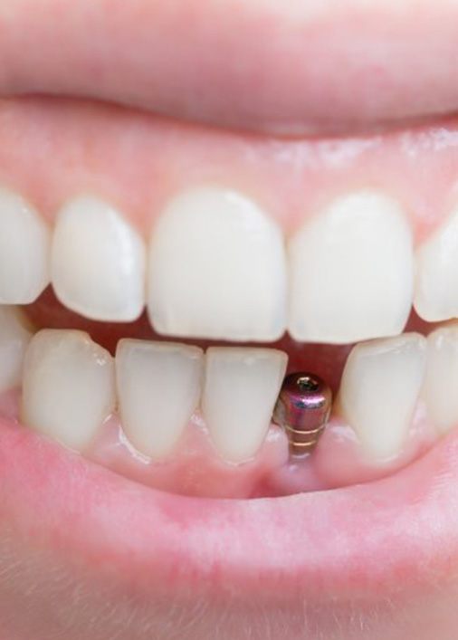 Smile with dental implant
