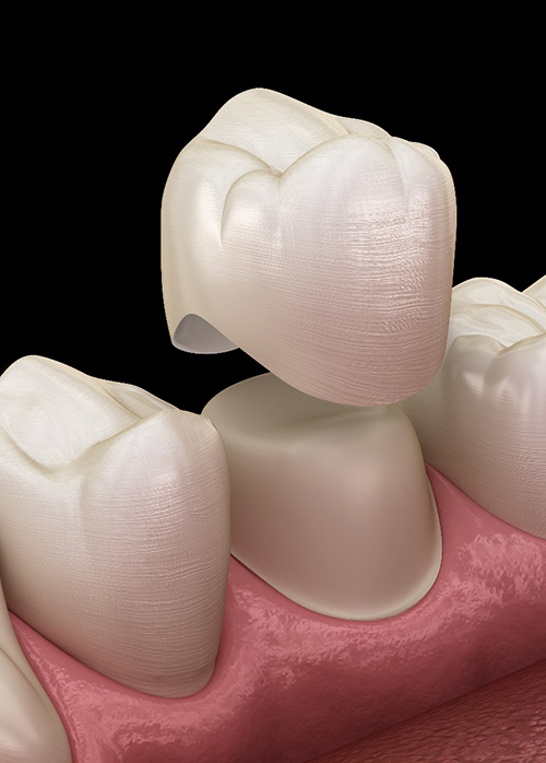 Illustration of dental crown being placed on bottom tooth