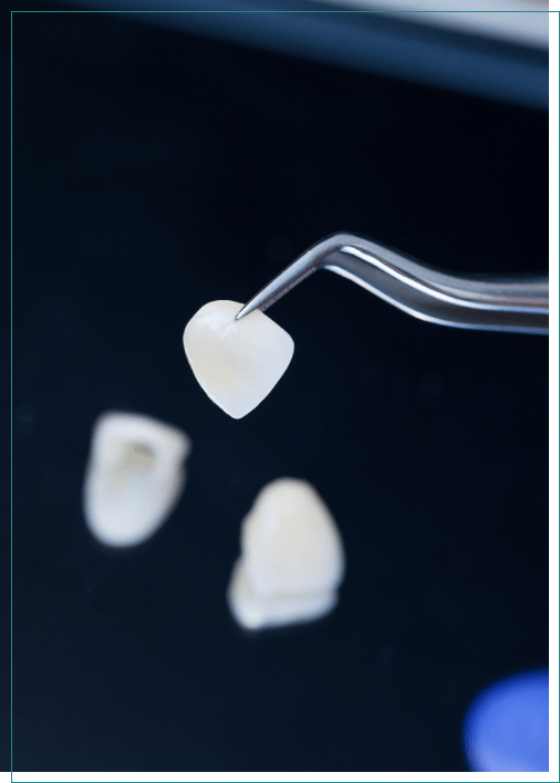 Dentist holding a veneer in a pair of tweezers