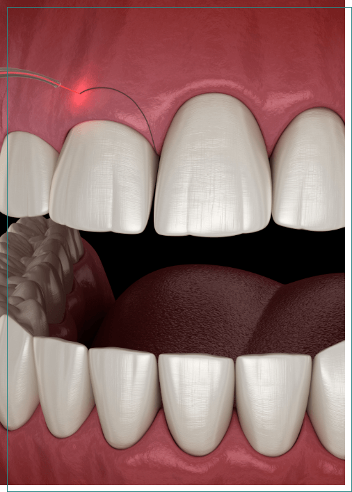 Illustrated dental laser treating a gummy smile