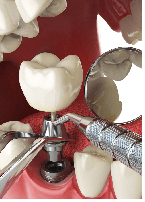 Illustrated dental implant being placed into the lower jaw