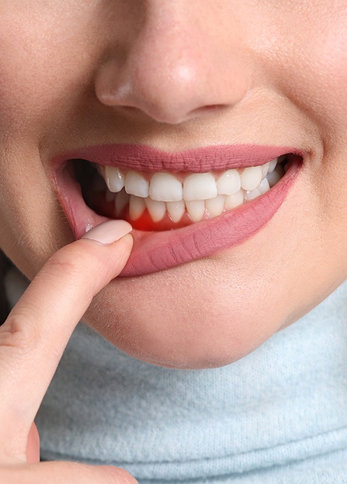 a woman pulling down her lip to reveal irritated gums