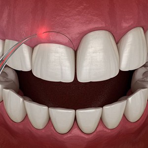 Illustration of laser being used for gum recontouring