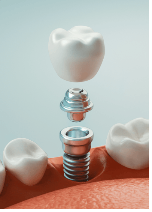 Illustrated dental implant replacing a missing tooth