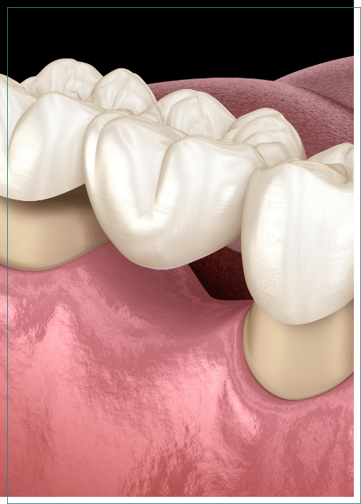 Illustrated dental bridge replacing a missing tooth