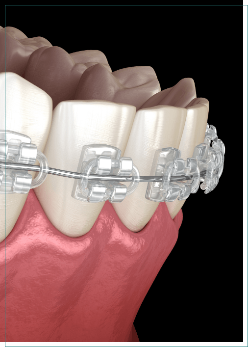 Illustrated row of teeth with braces with clear brackets
