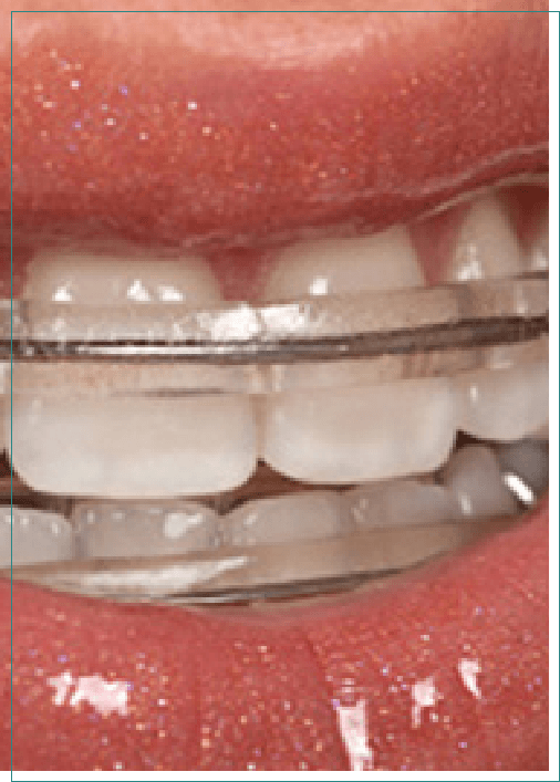 Close up of teeth with Inman Aligners