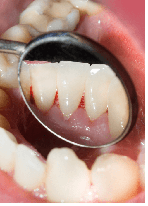 Close up of dental mirror inside of mouth