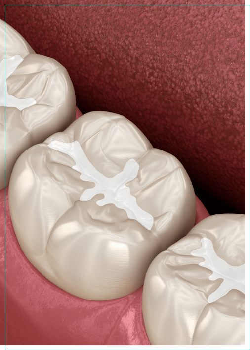 Illustrated row of teeth with dental sealants