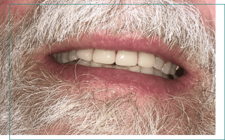 Man with white beard and full set of teeth