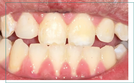 Close up of mouth after correcting chipped tooth