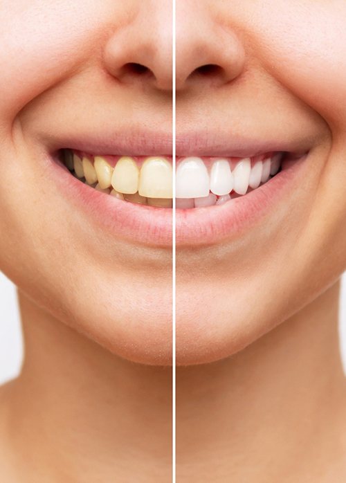 Closeup of patient's smile before and after teeth whitening
