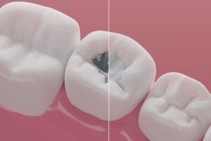 Illustration of tooth before and after replacing a metal filling 