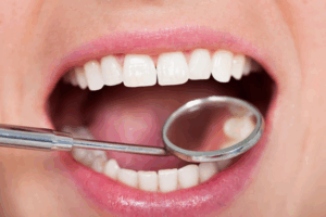 Close up of a dental mirror inspecting a patient’s teeth