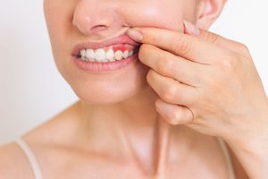 Nose-to-shoulder view of woman pulling back upper lip to reveal dark red gums
